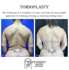 Torsoplastia- Dr Rodrigo Valero
