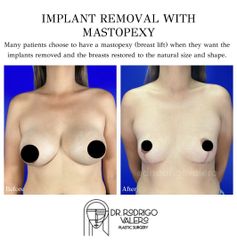 Extracción de implantes con Mastopexia -Dr Rodrigo Valero