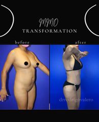 Liposucción - Dr. Rodrigo Valero Jarillo