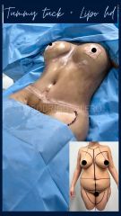 Lipoescultura - Dr. Rodrigo Valero Jarillo