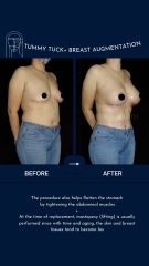 Tummy tuck + Aumento busto - Dr Rodrigo Valero