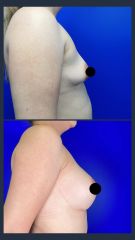 Aumento de busto - Dr. Rodrigo Valero Jarillo