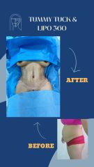 Abdominoplastia - Dr. Rodrigo Valero Jarillo