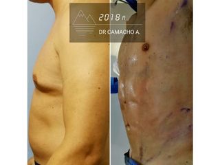 Liposucción con Marcaje Abdominal de alta definición - Dr. Rodrigo Camacho Acosta