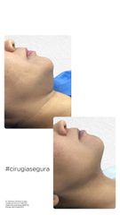 Liposucción de cuello - Dr. Rodrigo Camacho Acosta