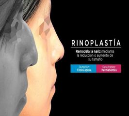Rinoplastia  - Dr. Rodrigo Camacho Acosta