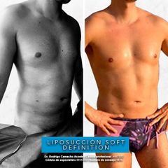 Antes y después de Liposucción soft definition 