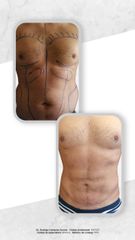Antes y después de Liposucción