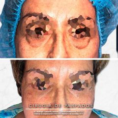 Antes y después de Cirugía de párpados