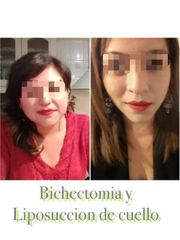 Antes y después de Liposucción de cuello + Bichectomia 