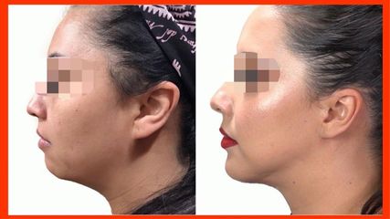 Antes y después de Liposucción de cuello + Aumento de mentón