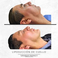 LIPOSUCCION DE CUELLO -Dr. Rodrigo Camacho Acosta