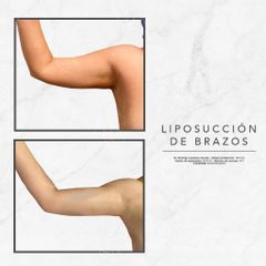 Liposucción brazos - Dr. Rodrigo Camacho Acosta