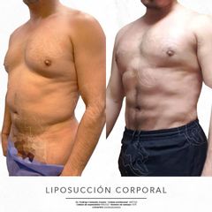 Liposucción - Dr. Rodrigo Camacho Acosta