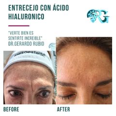Ácido hialurónico - Dr. Gerardo Rubio