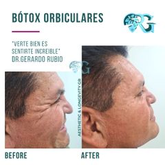 Botox - Dr. Gerardo Rubio