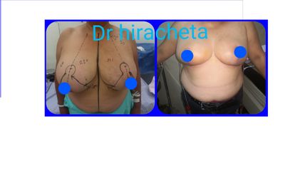 Antes y después de Reducción de mamas 