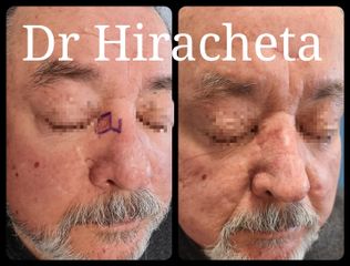Antes y después de Carcinoma basocelular 
