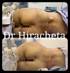 Antes y después de Gluteoplastia 