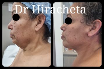 Cirugía facial - Dr. Alberto Hiracheta