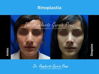 Rinoplastia - Dr. Jorge Humberto García Romo