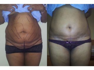 Abdominoplastyka - przed i po