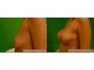 Powiększanie biustu - ClinicForYou
