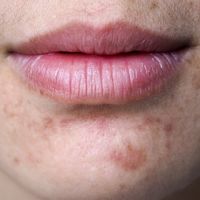 Cicatrices y manchas post-acné: ¿Cómo eliminarlas?