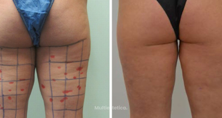 Lipoescultura Ultrasonica High-Definition 3D. VaserLipo y Vasersmooth