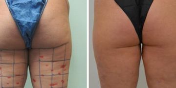 Lipoescultura Ultrasonica High-Definition 3D. VaserLipo y Vasersmooth Lipoescultura Ultrasonica High-Definition 3D. VaserLipo y Vasersmooth