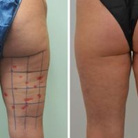 Lipoescultura Ultrasonica High-Definition 3D. VaserLipo y Vasersmooth