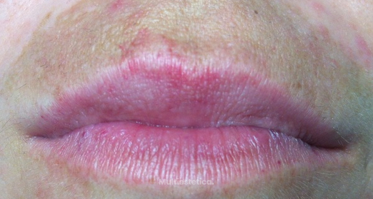 La hiperpigmentación del labio superior: causas y remedios