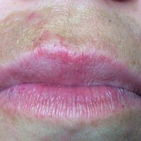 La hiperpigmentación del labio superior: causas y remedios