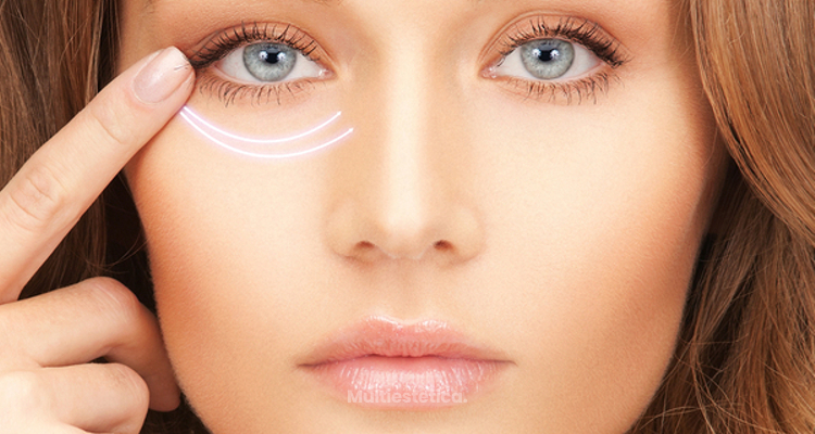 Ojeras: nueva solución con ácido hialurónico