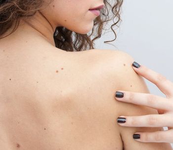 El test que informa sobre el riesgo de padecer melanoma
