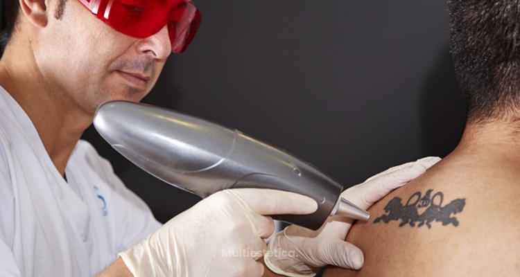 Eliminar tatuajes: ¿láser o cirugía?