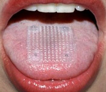 La malla lingual no está autorizada en España