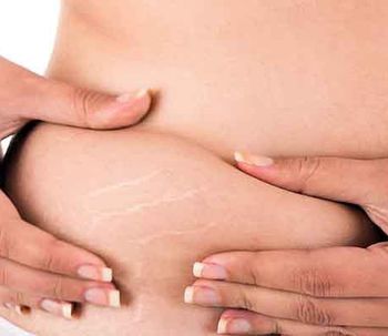 Las estrías, ¿qué son y cómo prevenirlas?