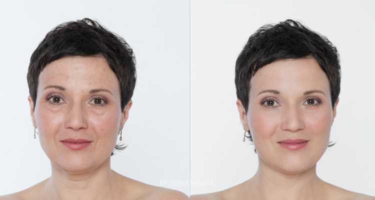 Blefaroplastia inferior: ¿qué es?