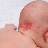 Las manchas de nacimiento: tipos y tratamientos