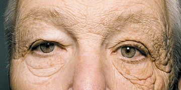 La aparición de arrugas en la piel a causa del sol