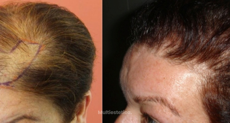 La alopecia en la mujer, ¿un problema sin solución?