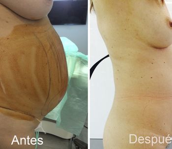El Vaser Lipo: la alternativa perfecta a la liposucción tradicional