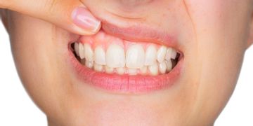 Cómo tratar la sonrisa gingival