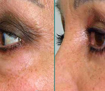 Blefaroplastia: tipos de cirugía y recuperación