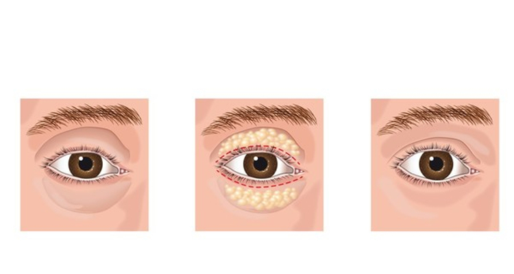 Blefaroplastia inferior antes y despues de adelgazar Blefaroplastia inferior antes y despues de adelgazar