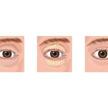 ¿Qué es una blefaroplastia?