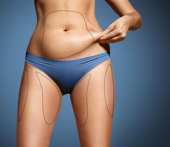 Cómo es la liposucción safeLipo