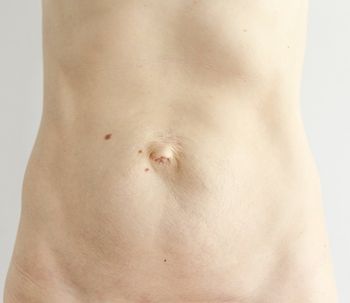 Qué es la diástasis abdominal y cómo corregirla
