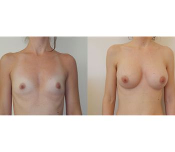 La verdadera operación bikini: desmontar los tópicos sobre el aumento de pecho en verano